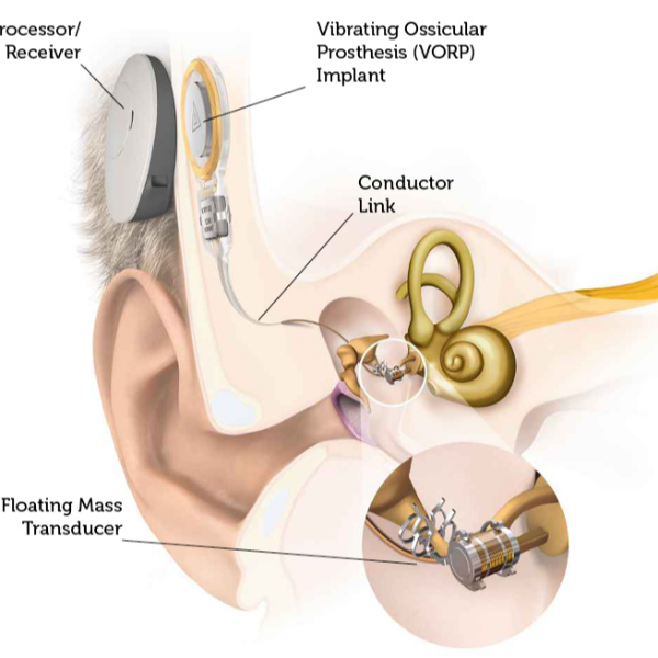 植入中耳(Middle Ear Transducer)是什么？