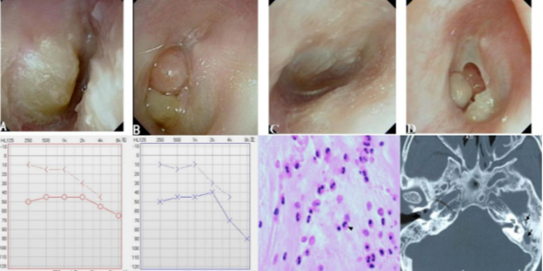 顽固性中耳炎-上篇